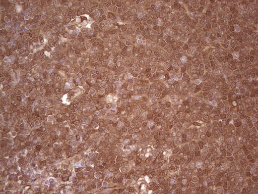 IHC of paraffin-embedded Human lymphoma tissue using anti-LGALS9 mouse monoclonal antibody. (Heat-induced epitope retrieval by 1 mM EDTA in 10mM Tris, pH8.5, 120°C for 3min).