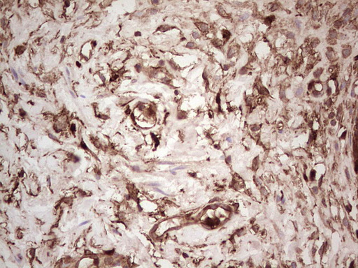 IHC of paraffin-embedded Carcinoma of Human bladder tissue using anti-LGALS9 mouse monoclonal antibody. (Heat-induced epitope retrieval by 1 mM EDTA in 10mM Tris, pH8.5, 120°C for 3min).