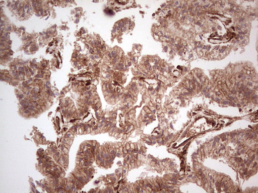 IHC of paraffin-embedded Carcinoma of Human prostate tissue using anti-LGALS9 mouse monoclonal antibody. (Heat-induced epitope retrieval by 1 mM EDTA in 10mM Tris, pH8.5, 120°C for 3min).