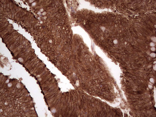 IHC of paraffin-embedded Adenocarcinoma of Human colon tissue using anti-LGALS9 mouse monoclonal antibody. (Heat-induced epitope retrieval by 1 mM EDTA in 10mM Tris, pH8.5, 120°C for 3min).