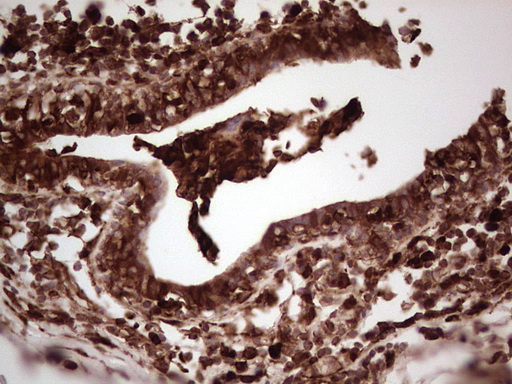 IHC of paraffin-embedded Adenocarcinoma of Human breast tissue using anti-LGALS9 mouse monoclonal antibody. (Heat-induced epitope retrieval by 1 mM EDTA in 10mM Tris, pH8.5, 120°C for 3min).