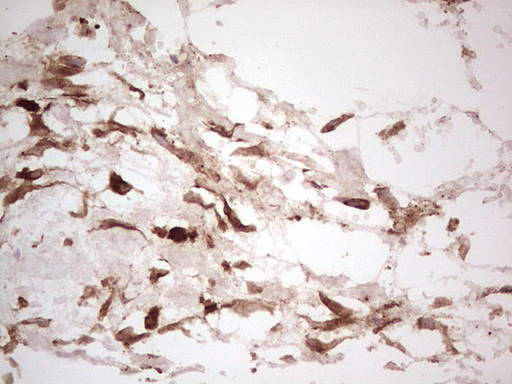 IHC of paraffin-embedded Carcinoma of Human kidney tissue using anti-LGALS9 mouse monoclonal antibody. (Heat-induced epitope retrieval by 1 mM EDTA in 10mM Tris, pH8.5, 120°C for 3min).