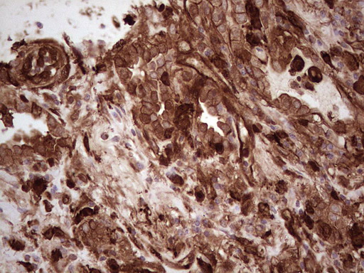 IHC of paraffin-embedded Carcinoma of Human lung tissue using anti-LGALS9 mouse monoclonal antibody. (Heat-induced epitope retrieval by 1 mM EDTA in 10mM Tris, pH8.5, 120°C for 3min).