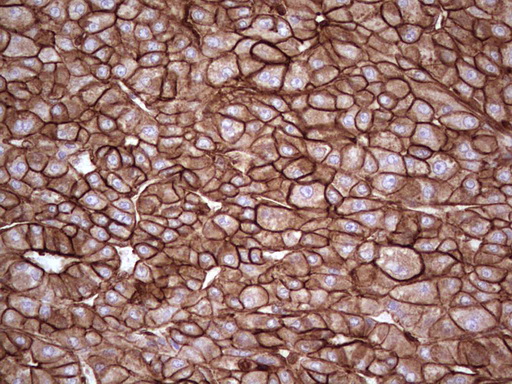 IHC of paraffin-embedded Carcinoma of Human liver tissue using anti-LGALS9 mouse monoclonal antibody. (Heat-induced epitope retrieval by 1 mM EDTA in 10mM Tris, pH8.5, 120°C for 3min).