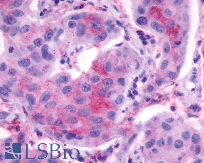 Anti-LHCGR / LHR / LH Receptor antibody IHC of human Breast, Carcinoma. Immunohistochemistry of formalin-fixed, paraffin-embedded tissue after heat-induced antigen retrieval.