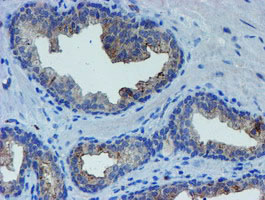 IHC of paraffin-embedded Carcinoma of Human prostate tissue using anti-LHX1 mouse monoclonal antibody. (Heat-induced epitope retrieval by 10mM citric buffer, pH6.0, 100C for 10min).