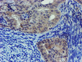 IHC of paraffin-embedded Adenocarcinoma of Human endometrium tissue using anti-LHX1 mouse monoclonal antibody. (Heat-induced epitope retrieval by 10mM citric buffer, pH6.0, 100C for 10min).