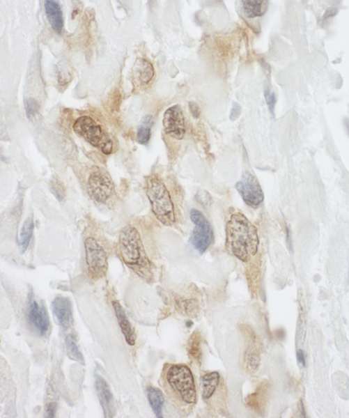 Detection of Human LPP by Immunohistochemistry. Sample: FFPE section of human osteosarcoma. Antibody: Affinity purified rabbit anti-LPP used at a dilution of 1:250.