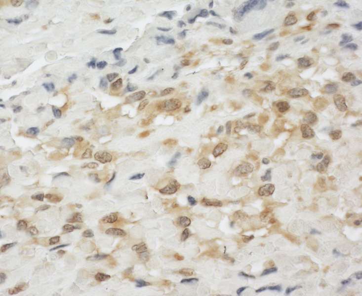 Detection of Human LPP by Immunohistochemistry. Sample: FFPE section of human osteosarcoma. Antibody: Affinity purified rabbit anti-LPP used at a dilution of 1:200 (1 Detection: DAB.
