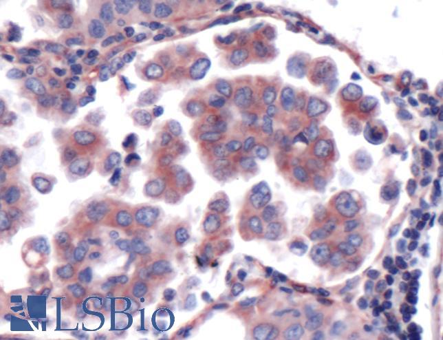 Immunohistochemistry of Human Lung Carcinoma stained with anti-LIMD1 antibody