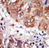 Formalin-fixed and paraffin-embedded human cancer tissue reacted with the primary antibody, which was peroxidase-conjugated to the secondary antibody, followed by DAB staining. This data demonstrates the use of this antibody for immunohistochemistry; clinical relevance has not been evaluated. BC = breast carcinoma; HC = hepatocarcinoma.