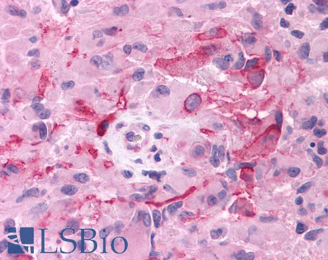 Anti-GRM3 / MGLUR3 antibody IHC of human Brain, Glioblastoma. Immunohistochemistry of formalin-fixed, paraffin-embedded tissue after heat-induced antigen retrieval.