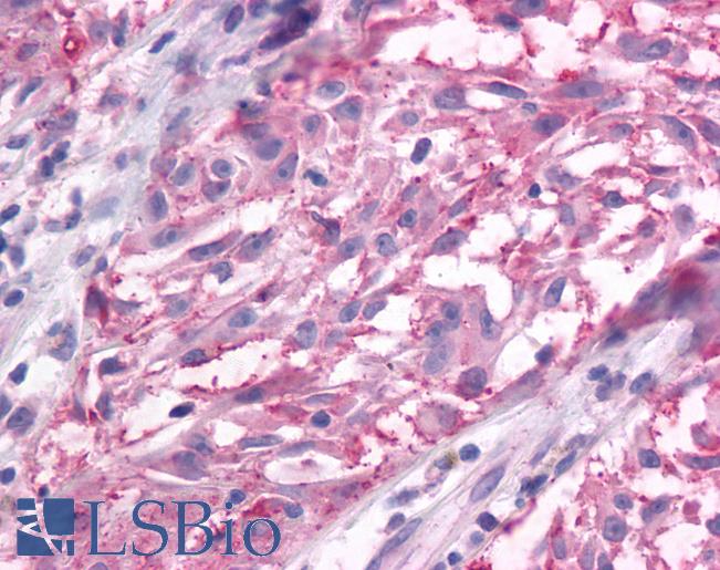 Anti-GRM3 / MGLUR3 antibody IHC of human Skin, Melanoma. Immunohistochemistry of formalin-fixed, paraffin-embedded tissue after heat-induced antigen retrieval.