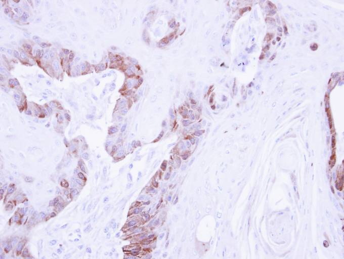 IHC of paraffin-embedded CA922 xenograft using LIM kinase 2 antibody at 1:500 dilution.