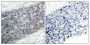 IHC of paraffin-embedded human breast carcinoma, using LIMK2 (Phospho-Thr505) Antibody. The sample on the right was incubated with synthetic peptide.