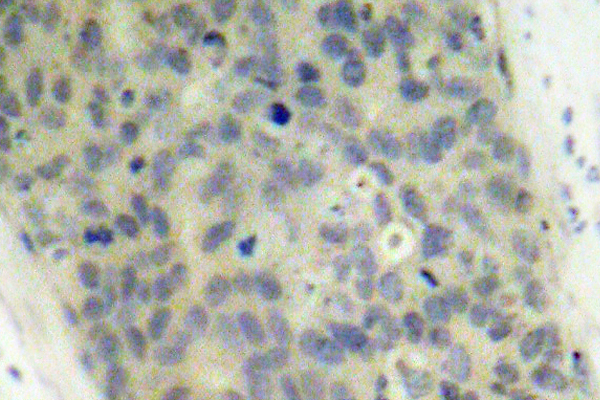 IHC of p-LIMK2 (T505) pAb in paraffin-embedded human breast carcinoma tissue.