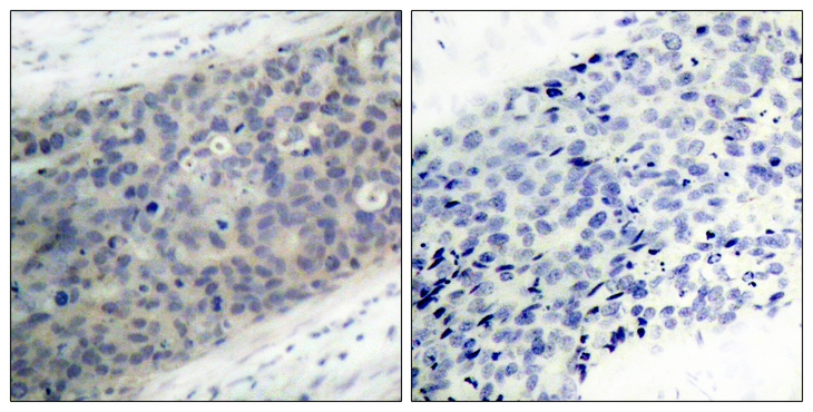 Immunohistochemistry of paraffin-embedded human breast carcinoma tissue using LIMK2(Phospho-Thr505) antibody (left) or the same antibody preincubated with blocking peptide (right).