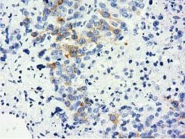 IHC of paraffin-embedded Adenocarcinoma of Human ovary tissue using anti-LIN7B mouse monoclonal antibody. (Dilution 1:50).