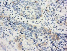 IHC of paraffin-embedded Carcinoma of Human bladder tissue using anti-LIN7B mouse monoclonal antibody. (Dilution 1:50).