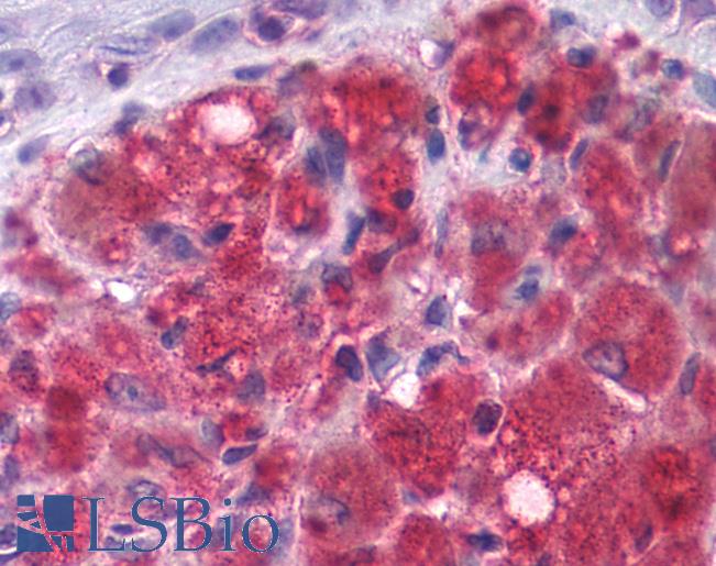 Anti-GRM3 / MGLUR3 antibody IHC of human Skin, Melanoma. Immunohistochemistry of formalin-fixed, paraffin-embedded tissue after heat-induced antigen retrieval.