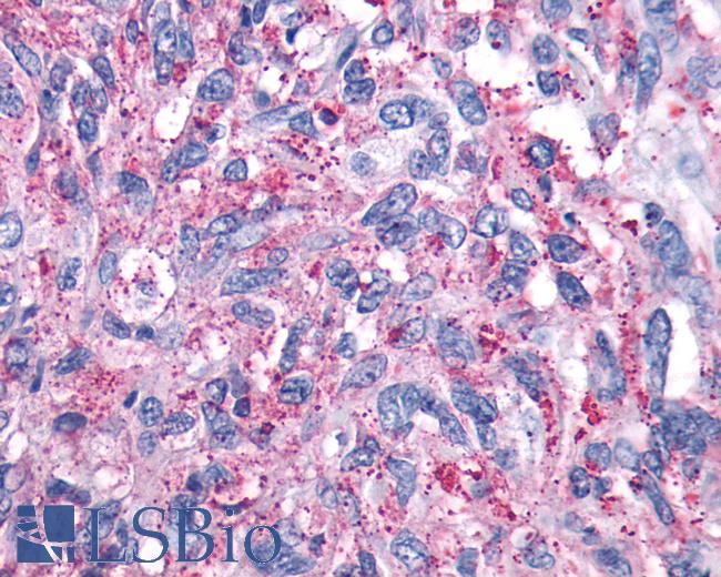 Anti-GRM4 / MGLUR4 antibody IHC of human Brain, Glioblastoma. Immunohistochemistry of formalin-fixed, paraffin-embedded tissue after heat-induced antigen retrieval.