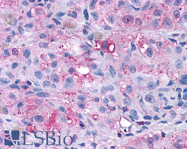 Anti-GRM4 / MGLUR4 antibody IHC of human Skin, Melanoma. Immunohistochemistry of formalin-fixed, paraffin-embedded tissue after heat-induced antigen retrieval.