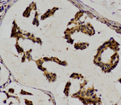 IHC of HSL pAb in paraffin-embedded human breast carcinoma tissue.