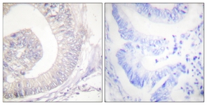 IHC of paraffin-embedded human colon carcinoma, using HSL (Phospho-Ser855/554) Antibody. The sample on the right was incubated with synthetic peptide.
