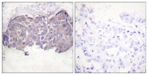 IHC of paraffin-embedded human breast carcinoma, using HSL (Phospho-Ser552) Antibody. The sample on the right was incubated with synthetic peptide.