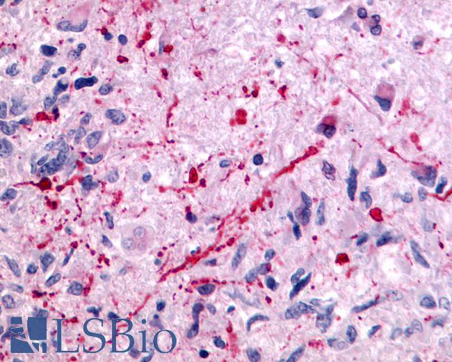 Anti-GRM5 / MGLUR5 antibody IHC of human Brain, Glioblastoma. Immunohistochemistry of formalin-fixed, paraffin-embedded tissue after heat-induced antigen retrieval.