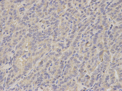 Immunohistochemistry of paraffin-embedded human thyroid cancer using LITAF antibody at dilution of 1:200 (400x lens).
