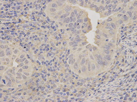 Immunohistochemistry of paraffin-embedded human endometrial cancer using LITAF antibody at dilution of 1:200 (400x lens).