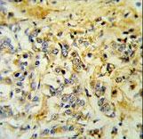 LMBR1L Antibody IHC of formalin-fixed and paraffin-embedded breast carcinoma followed by peroxidase-conjugated secondary antibody and DAB staining.
