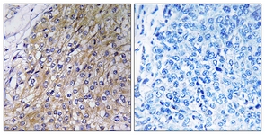 IHC of paraffin-embedded human breast carcinoma tissue, using GOLT1A Antibody. The sample on the right was incubated with synthetic peptide.