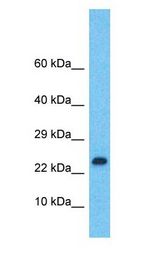 LMO2 antibody Western Blot of Ovary Tumor. Antibody dilution: 1 ug/ml.