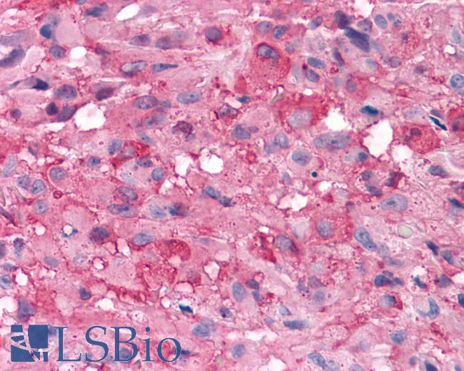 Anti-GRM7 / MGLUR7 antibody IHC of human Brain, Glioblastoma. Immunohistochemistry of formalin-fixed, paraffin-embedded tissue after heat-induced antigen retrieval.