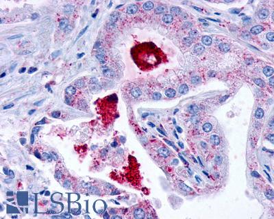 Anti-LPAR3 / LPA3 / EDG7 antibody IHC of human Prostate, Carcinoma. Immunohistochemistry of formalin-fixed, paraffin-embedded tissue after heat-induced antigen retrieval.