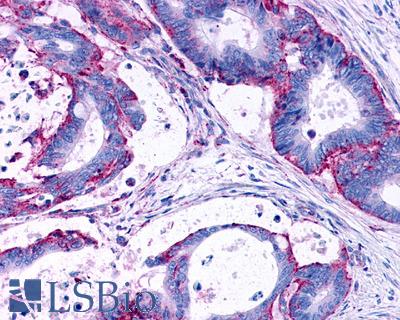 Anti-LPAR3 / LPA3 / EDG7 antibody IHC of human Colon, Carcinoma. Immunohistochemistry of formalin-fixed, paraffin-embedded tissue after heat-induced antigen retrieval.