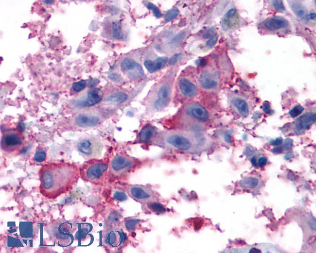 Anti-GRM7 / MGLUR7 antibody IHC of human Skin, Melanoma. Immunohistochemistry of formalin-fixed, paraffin-embedded tissue after heat-induced antigen retrieval.