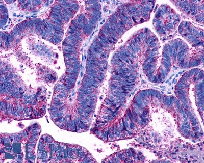 Anti-LPAR3 / LPA3 / EDG7 antibody IHC of human Colon, Carcinoma. Immunohistochemistry of formalin-fixed, paraffin-embedded tissue after heat-induced antigen retrieval.