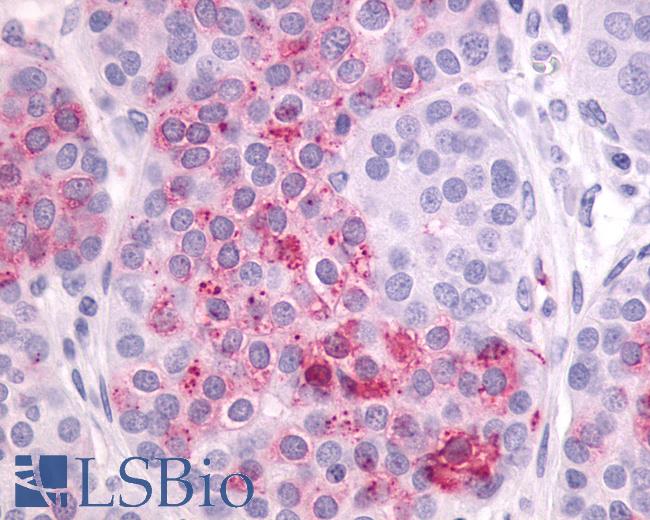 Anti-LPAR4 / GPR23 antibody IHC of human Ovary, Carcinoma. Immunohistochemistry of formalin-fixed, paraffin-embedded tissue after heat-induced antigen retrieval.
