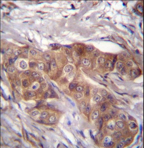 LPAR6 Antibody immunohistochemistry of formalin-fixed and paraffin-embedded human breast carcinoma followed by peroxidase-conjugated secondary antibody and DAB staining.