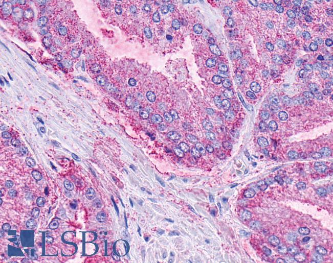Anti-LPAR6 / P2RY5 / P2Y5 antibody IHC of human Prostate, Carcinoma. Immunohistochemistry of formalin-fixed, paraffin-embedded tissue after heat-induced antigen retrieval.