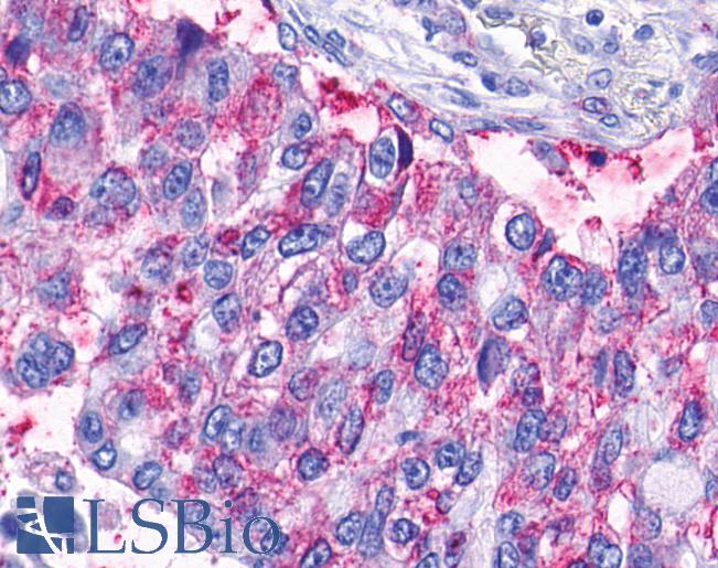 Anti-LPAR6 / P2RY5 / P2Y5 antibody IHC of human Lung, Adenocarcinoma. Immunohistochemistry of formalin-fixed, paraffin-embedded tissue after heat-induced antigen retrieval.