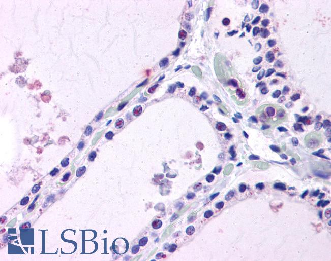 Anti-LPCAT1 antibody LS-A9904 IHC of human thyroid. Immunohistochemistry of formalin-fixed, paraffin-embedded tissue after heat-induced antigen retrieval.