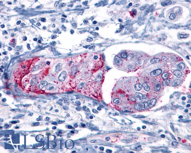 Anti-GRM8 / MGLUR8 antibody IHC of human Pancreas, Carcinoma. Immunohistochemistry of formalin-fixed, paraffin-embedded tissue after heat-induced antigen retrieval.