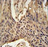 LPPR4 Antibody immunohistochemistry of formalin-fixed and paraffin-embedded human lung carcinoma followed by peroxidase-conjugated secondary antibody and DAB staining.