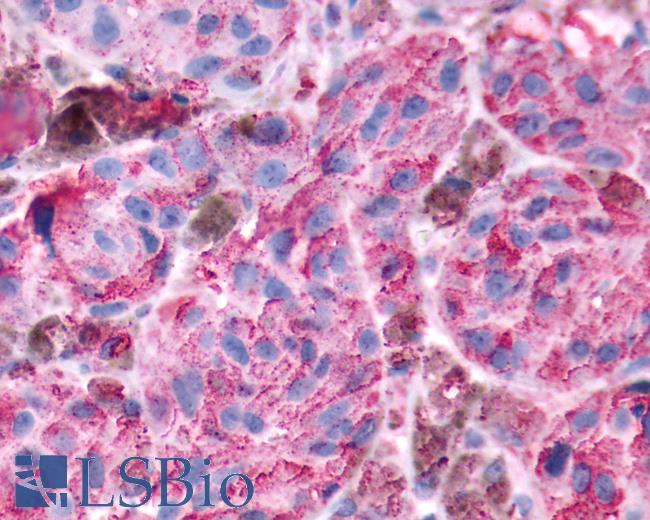 Anti-GRM8 / MGLUR8 antibody IHC of human Skin, Melanoma. Immunohistochemistry of formalin-fixed, paraffin-embedded tissue after heat-induced antigen retrieval.