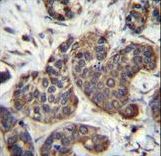 GOT1B Antibody immunohistochemistry of formalin-fixed and paraffin-embedded human bladder carcinoma followed by peroxidase-conjugated secondary antibody and DAB staining.