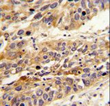 Formalin-fixed and paraffin-embedded human lung carcinoma reacted with LRG1 Antibody , which was peroxidase-conjugated to the secondary antibody, followed by DAB staining. This data demonstrates the use of this antibody for immunohistochemistry; clinical relevance has not been evaluated.